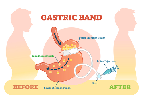 Lap Band Procedure Beverly Hills, CA