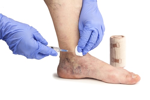 ClariVein Treatment Pomona