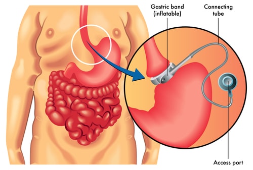 Lap Band Weight Loss Apple Valley