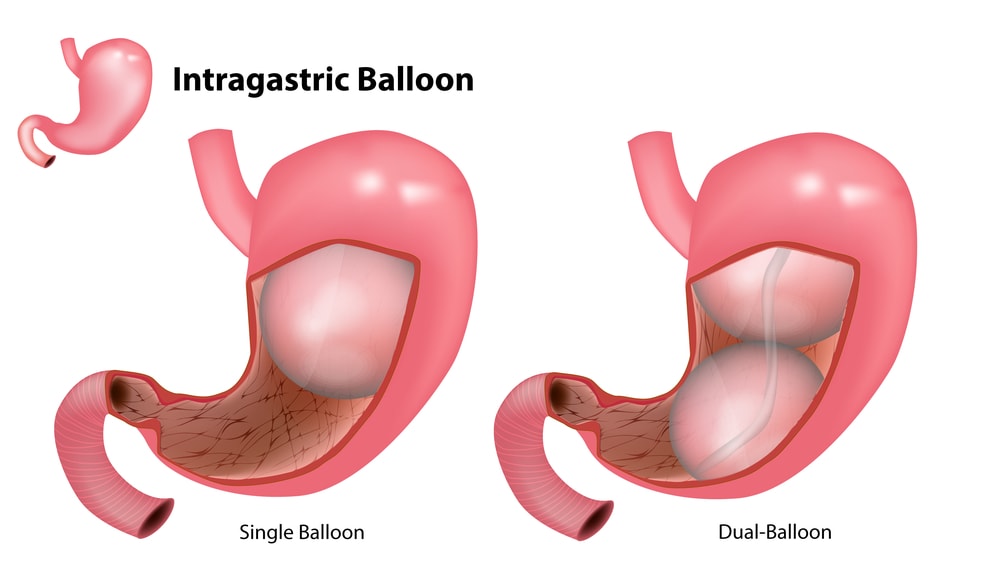 Gastric Balloon Pomona CA