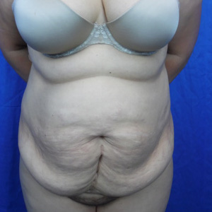 Tummy Tuck Before & After Patient #4042