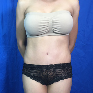 Tummy Tuck Before & After Patient #4045