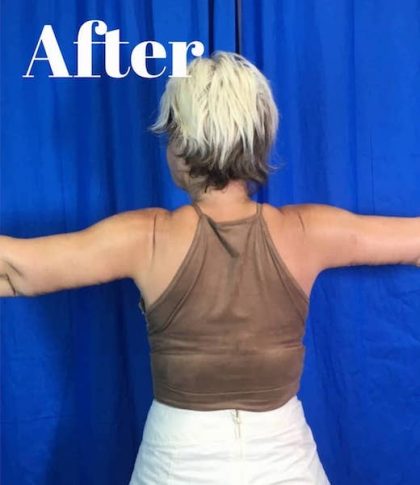 Arm Lift Before & After Patient #3949