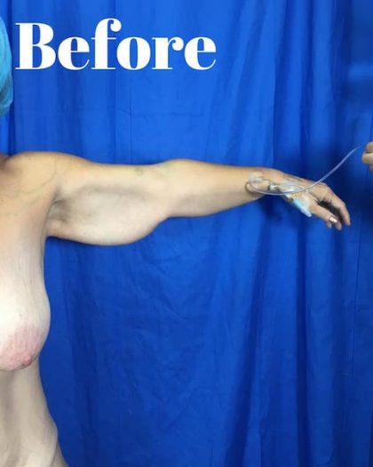 Arm Lift Before & After Patient #3949