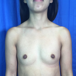 Breast Augmentation Before & After Patient #3972