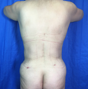Brazilian Butt Lift Before & After Patient #3957