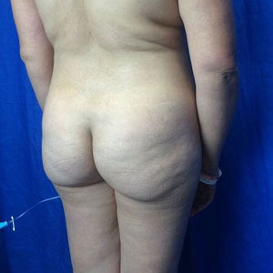 Brazilian Butt Lift Before & After Patient #3963