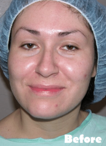 Facelift Before & After Patient #4001