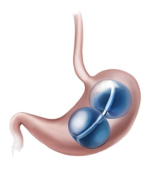 Gastric Balloon Procedure apple valley ca