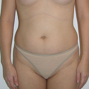 Liposuction Before & After Patient #4008