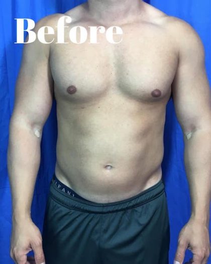 Liposuction Before & After Patient #4011