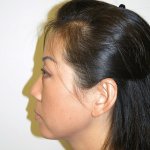 Neck Lift Before & After Patient #4029