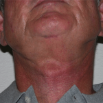 Neck Lift Before & After Patient #4016