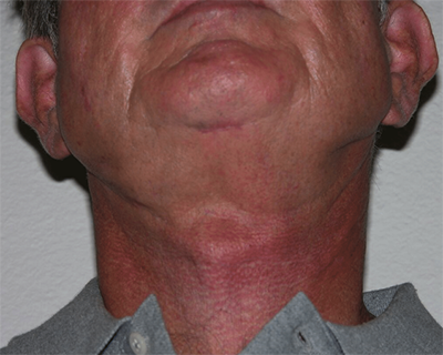Neck Lift Before & After Patient #4016