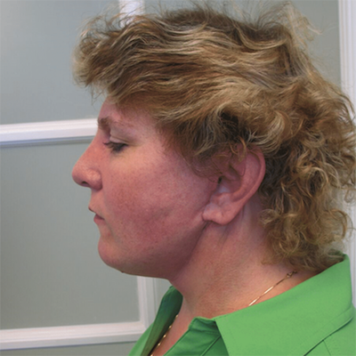 Neck Lift Before & After Patient #4021