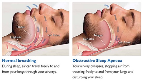 sleep apnea therapy pomona ca