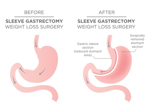 lap band procedure apple valley