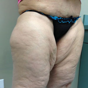 Thigh Lift Before & After Patient #4036