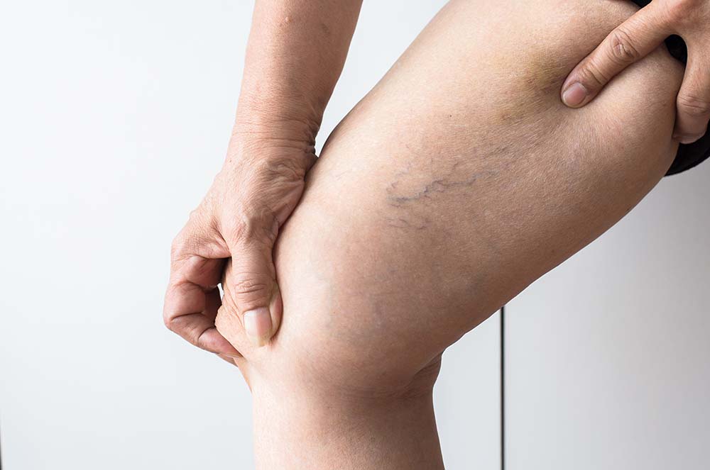 RF Ablation for Varicose Veins