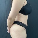 Tummy Tuck Before & After Patient #4437