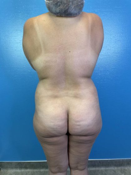 Tummy Tuck Before & After Patient #4439
