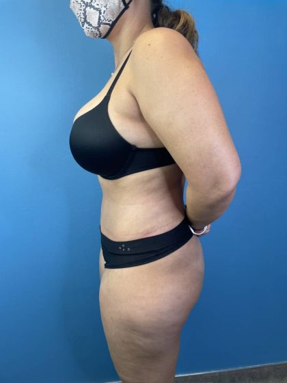 Tummy Tuck Before & After Patient #4439