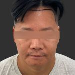 Hair Transplantation Before & After Patient #4756