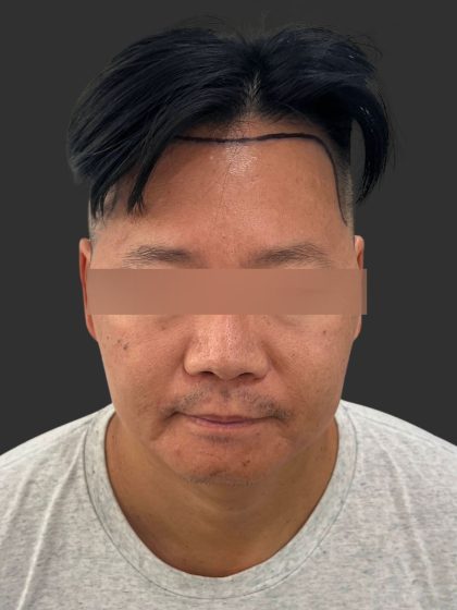 Hair Transplantation Before & After Patient #4756