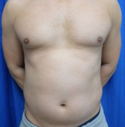 Liposuction Before & After Patient #4719