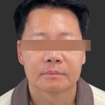 Hair Transplantation Before & After Patient #4756