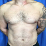 Liposuction Before & After Patient #4719