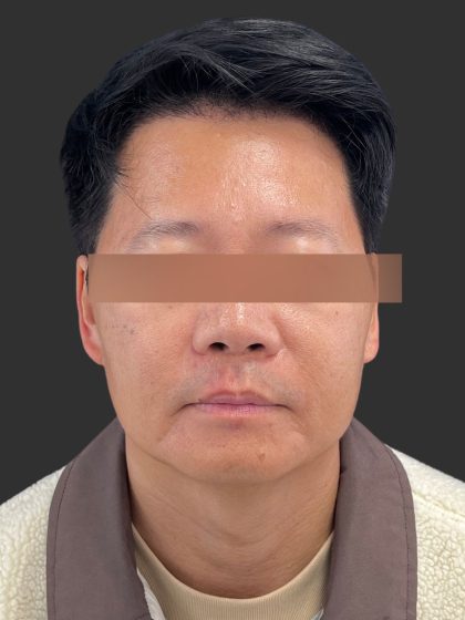 Hair Transplantation Before & After Patient #4756