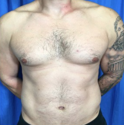 Liposuction Before & After Patient #4719
