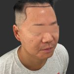 Hair Transplantation Before & After Patient #4756