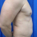 Liposuction Before & After Patient #4719