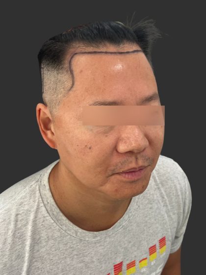 Hair Transplantation Before & After Patient #4756