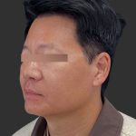 Hair Transplantation Before & After Patient #4756