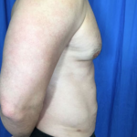 Liposuction Before & After Patient #4719