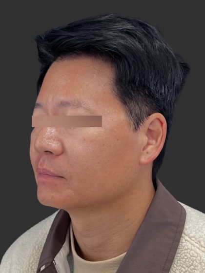Hair Transplantation Before & After Patient #4756