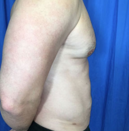 Liposuction Before & After Patient #4719