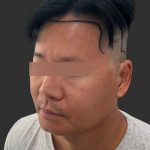 Hair Transplantation Before & After Patient #4756