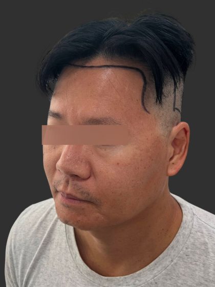 Hair Transplantation Before & After Patient #4756