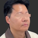 Hair Transplantation Before & After Patient #4756