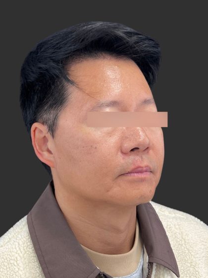 Hair Transplantation Before & After Patient #4756