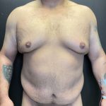 Gynecomastia Before & After Patient #4710