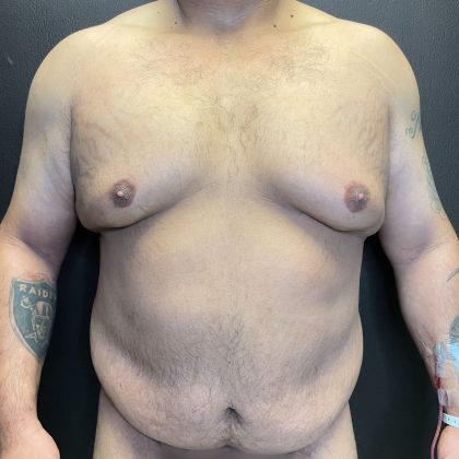 Gynecomastia Before & After Patient #4710