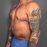 Gynecomastia Before & After Patient #4710