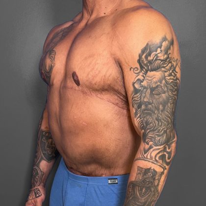 Gynecomastia Before & After Patient #4710