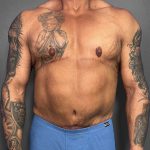 Gynecomastia Before & After Patient #4710