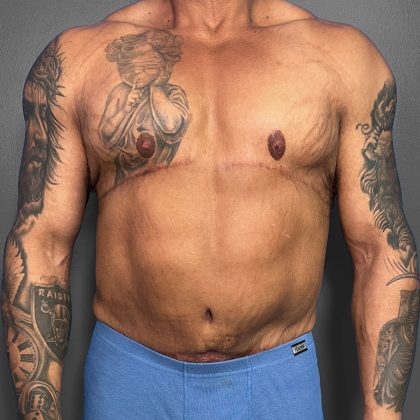 Gynecomastia Before & After Patient #4710